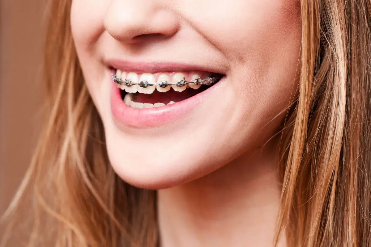 Braces